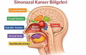 Sinonazal kanserler