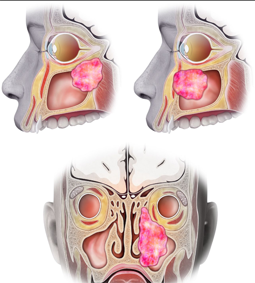 sinonazal-cancer1.png